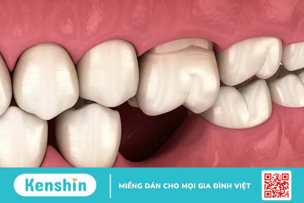 13 tuổi nhổ răng có mọc lại không? Các giai đoạn thay răng của trẻ