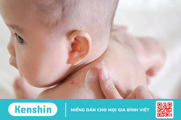 5 loại thuốc bôi ngoài da trị ngứa cho trẻ em an toàn và hiệu quả