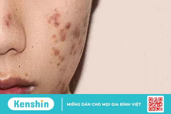 Alpha Arbutin có bắt nắng không và lưu ý khi sử dụng