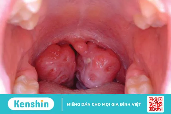 Amidan to bẩm sinh: Nguyên nhân, triệu chứng, cách điều trị