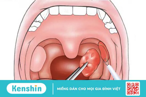 Amidan to bẩm sinh: Nguyên nhân, triệu chứng, cách điều trị