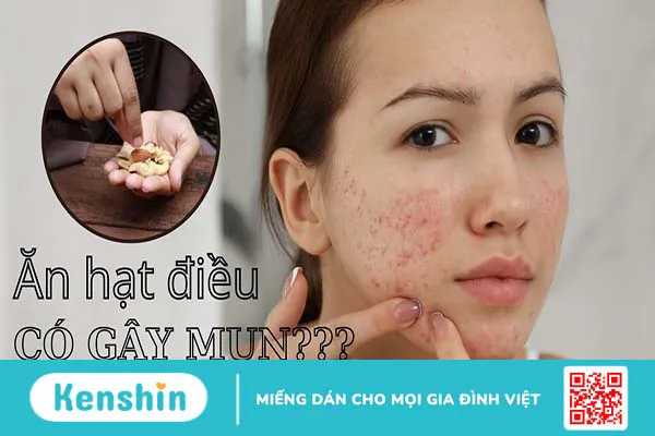 Ăn hạt điều có nổi mụn không?