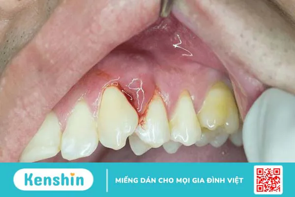 Áp xe nướu răng: Nguyên nhân, triệu chứng và cách chữa trị