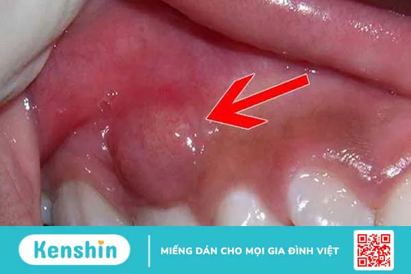 Áp xe nướu răng: Nguyên nhân, triệu chứng, biến chứng, cách phòng ngừa và chữa trị 1