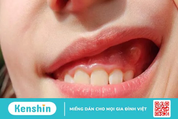 Áp xe nướu răng: Nguyên nhân, triệu chứng, biến chứng, cách phòng ngừa và chữa trị 2