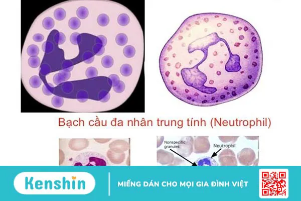 Bạch cầu đa nhân trung tính gây ra vấn đề sức khỏe nào? 2