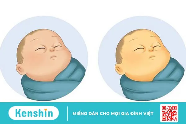 Bại não bẩm sinh: Triệu chứng, yếu tố nguy cơ và cách phòng ngừa 4