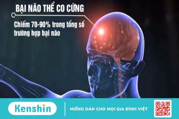 Bại não thể co cứng: Triệu chứng, chuẩn đoán và phương pháp điều trị