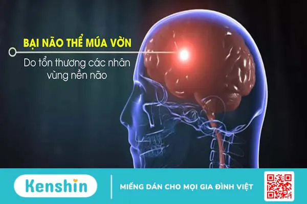 Phương pháp điều trị bại não thể múa vờn 1