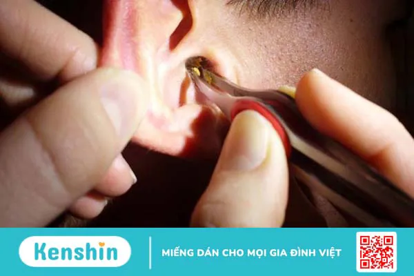 Bạn đã biết cách vệ sinh tai khi bị chảy mủ chưa?