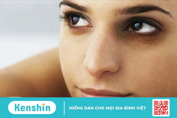 Bật mí cách trị thâm quầng mắt bẩm sinh đơn giản và hiệu quả 1