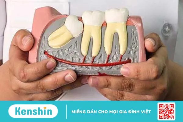 Bật mí một số phương pháp chỉnh răng mọc lệch không cần niềng