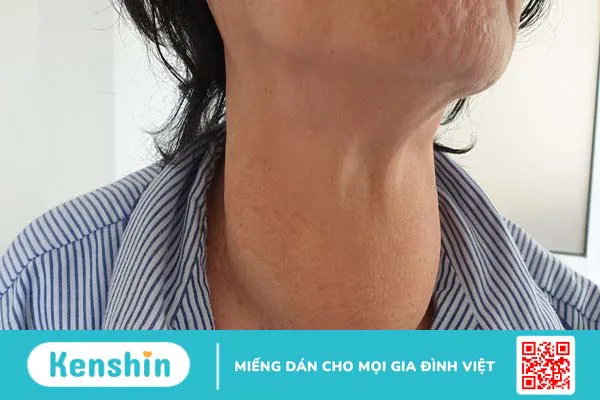 Bật mí những cây thuốc Nam chữa bệnh bướu cổ an toàn và hiệu quả