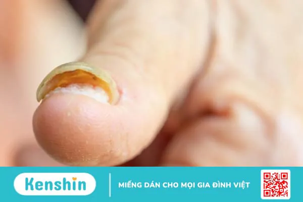 Bật móng tay sau thời gian bao lâu sẽ phục hồi? 1