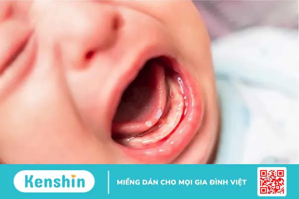 Nguyên nhân và cách điều trị khi bé bị nhiệt miệng hôi miệng 1