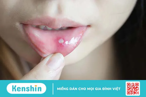 Nguyên nhân và cách điều trị khi bé bị nhiệt miệng hôi miệng 2