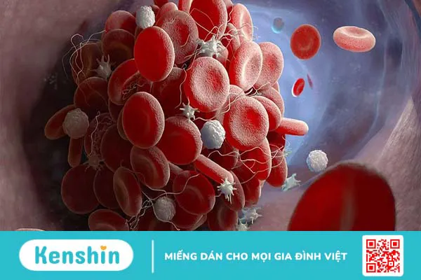 Bệnh Agglutinins lạnh là gì? Nguyên nhân, triệu chứng và cách điều trị bệnh 1