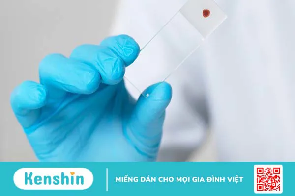 Bệnh Agglutinins lạnh là gì? Nguyên nhân, triệu chứng và cách điều trị bệnh 2