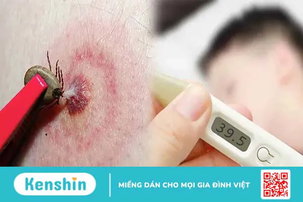 Bệnh Babesiosis (Babesia): Nguyên nhân, triệu chứng, chữa trị và cách phòng ngừa