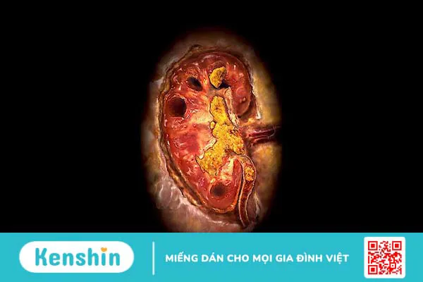 Bệnh cystin niệu: Nguyên nhân, triệu chứng, chẩn đoán và phương pháp điều trị