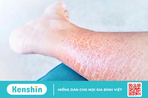 Bệnh da vảy cá bẩm sinh là bệnh gì? Nguyên nhân, triệu chứng và cách điều trị