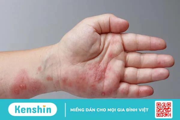 Bệnh giời leo có để lại sẹo không? Cách phòng ngừa và điều trị hiệu quả