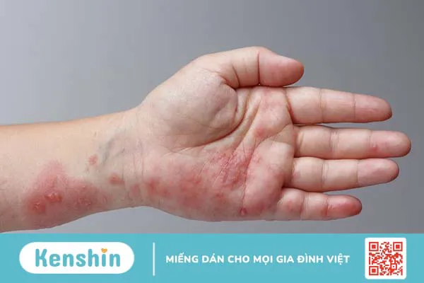 Bệnh giời leo có để lại sẹo không? Cách phòng ngừa và điều trị hiệu quả 1