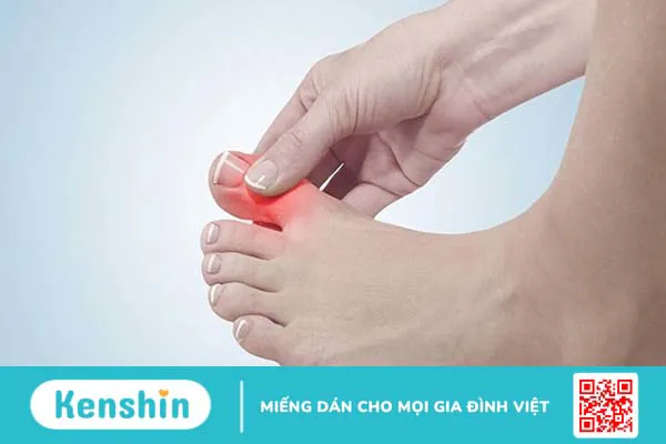 Bệnh gút có ăn được ớt không? Cần lưu ý những gì khi bị bệnh gút?