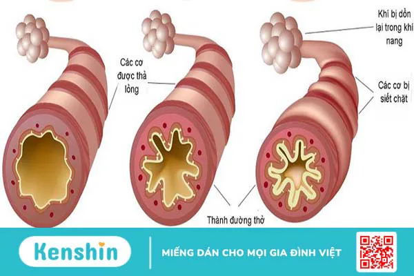 Bệnh hen suyễn có nguy hiểm không? Ngăn ngừa hen suyễn bằng cách nào? 2