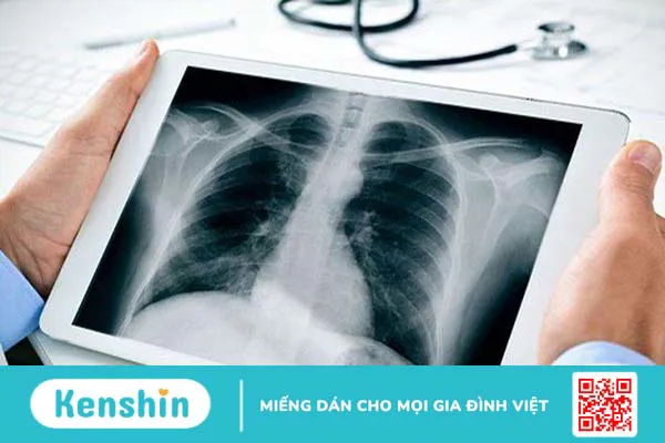 Bệnh lao cột sống có lây từ người này sang người khác không?