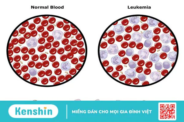 Bệnh Leukemia là gì? Cách chẩn đoán và điều trị bệnh Leukemia thế nào?