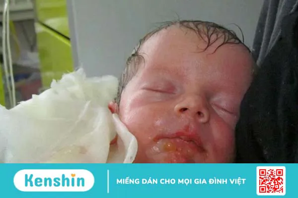 Bệnh ly thượng bì bẩm sinh có chữa được không?