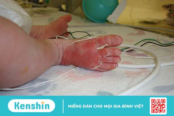 Bệnh ly thượng bì bẩm sinh có chữa được không?