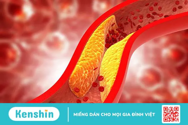 Bệnh mạch máu ngoại vi là gì? Triệu chứng của bệnh mạch máu ngoại vi như thế nào?