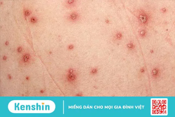 Bệnh nan y là gì? Phòng ngừa bệnh nan y bằng những thói quen đơn giản 2