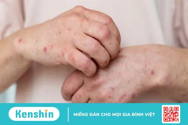 Bệnh nan y là gì? Phòng ngừa bệnh nan y bằng những thói quen đơn giản 4