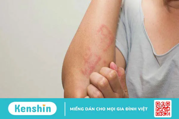 Bệnh OMC là gì và nguyên nhân, dấu hiệu, cách phòng ngừa