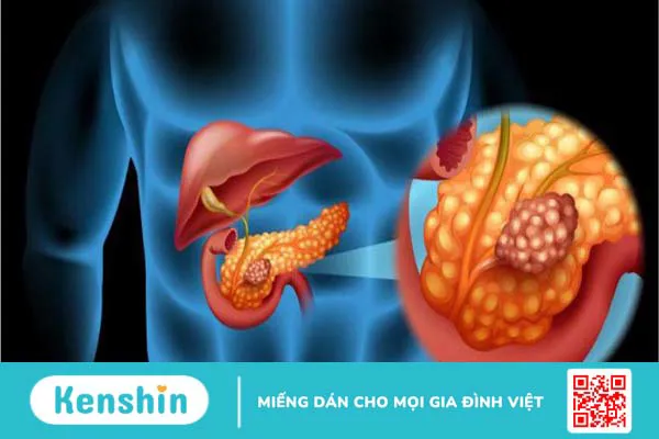 Bệnh OMC là gì và nguyên nhân, dấu hiệu, cách phòng ngừa