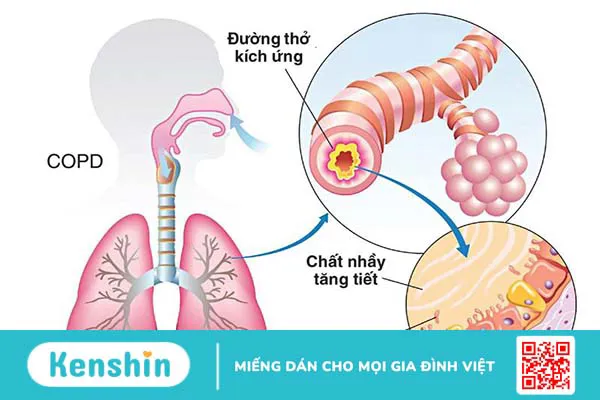 phoi-tac-nghen-man-tinh-giai-dap-cac-cau-hoi-thuong-gap-cung-bac-si-nguyen-van-my 2.webp