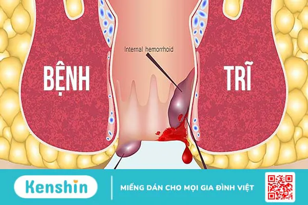 Bệnh trĩ nhiễm trùng: Nguyên nhân, triệu chứng, điều trị và phòng ngừa