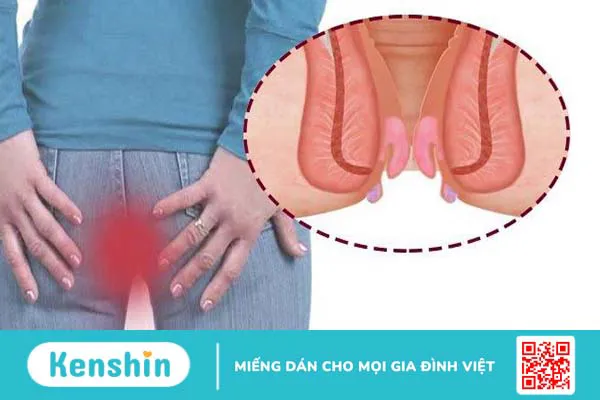 Bệnh trĩ nhiễm trùng: Nguyên nhân, triệu chứng, điều trị và phòng ngừa