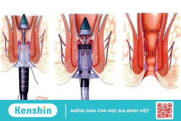 Bệnh trĩ nhiễm trùng: Nguyên nhân, triệu chứng, điều trị và phòng ngừa