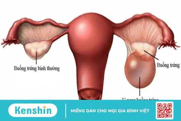 Bệnh u nang buồng trứng có gây ung thư không?