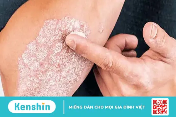 Bệnh vảy nến có trị được không?