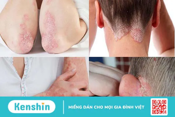 Bệnh vảy nến có trị được không?