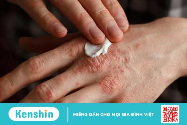 Bệnh vảy nến có trị được không?