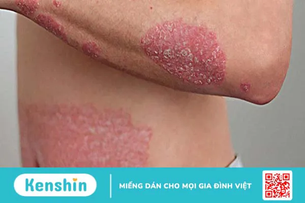 Bệnh vảy nến hồng có lây không? Triệu chứng của bệnh là gì?