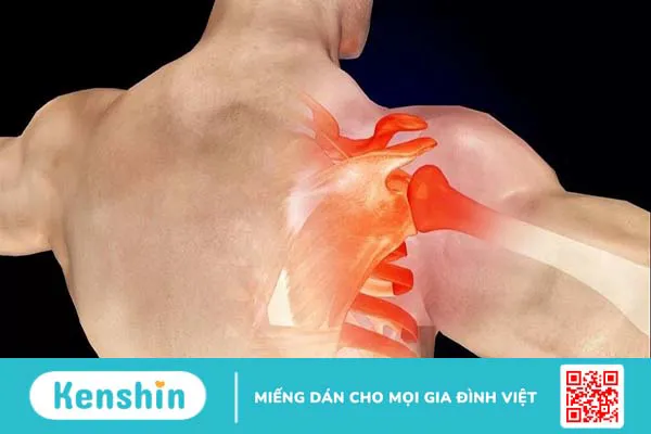 Bệnh viêm gân chóp xoay vai và phương pháp điều trị hiệu quả nhất hiện nay