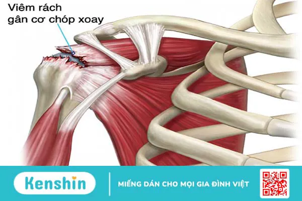 Bệnh viêm gân chóp xoay vai và phương pháp điều trị hiệu quả nhất hiện nay 2