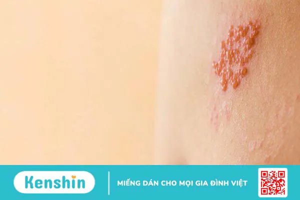 Liệt mặt vĩnh viễn do chủ quan khi bị Zona tai 1